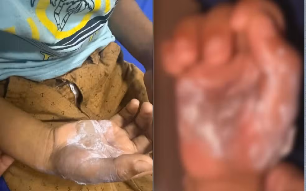 Mãe é presa em Goiás suspeita de queimar filho de sete anos